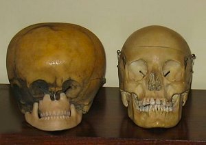 'Starchild Skull' cf. normal human skull